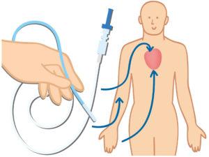 アブレーション用カテーテル